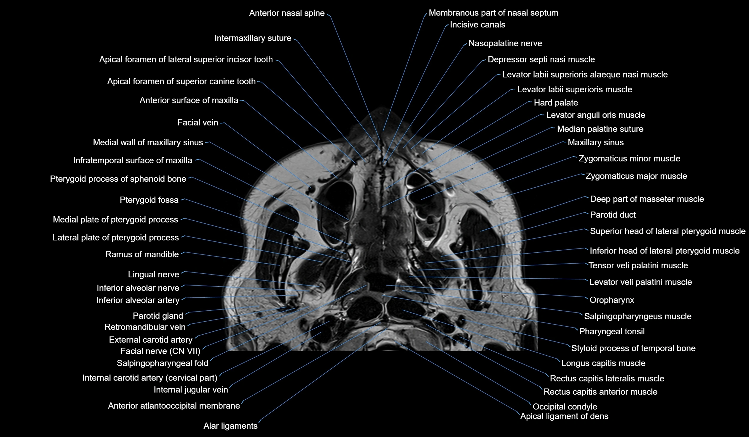 MRI face & paranasal sinuses(PNS) labelled  coronal  cross sectional anatomy 3T radiology  image-img-00001-00005.webp
